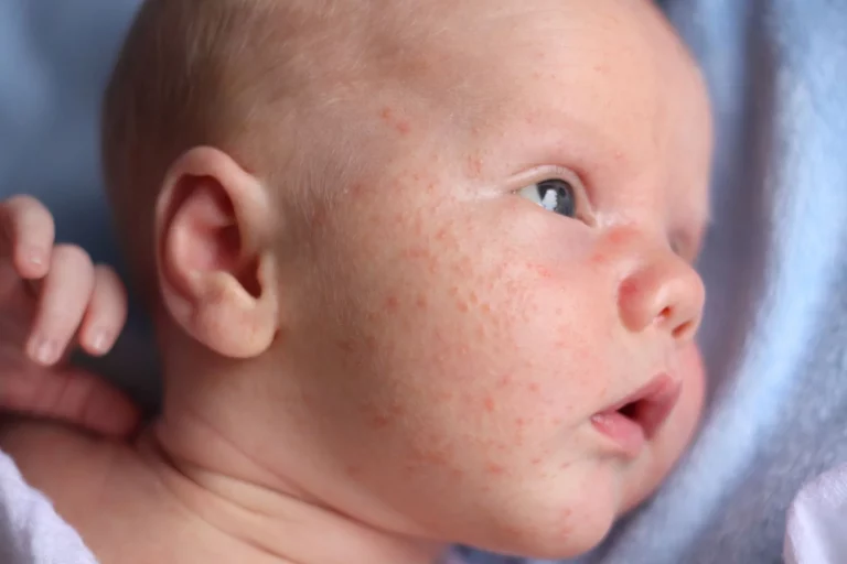 Alles over acne bij je baby